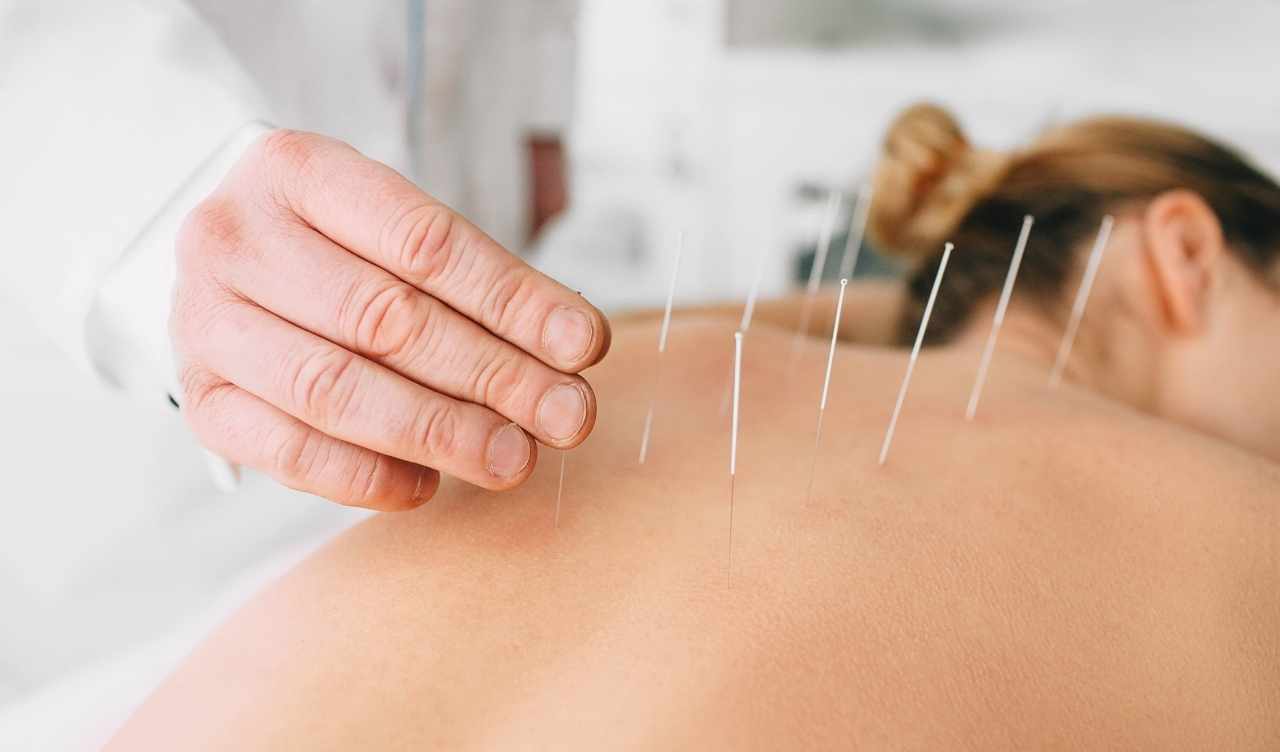 woman having acupuncture treatment