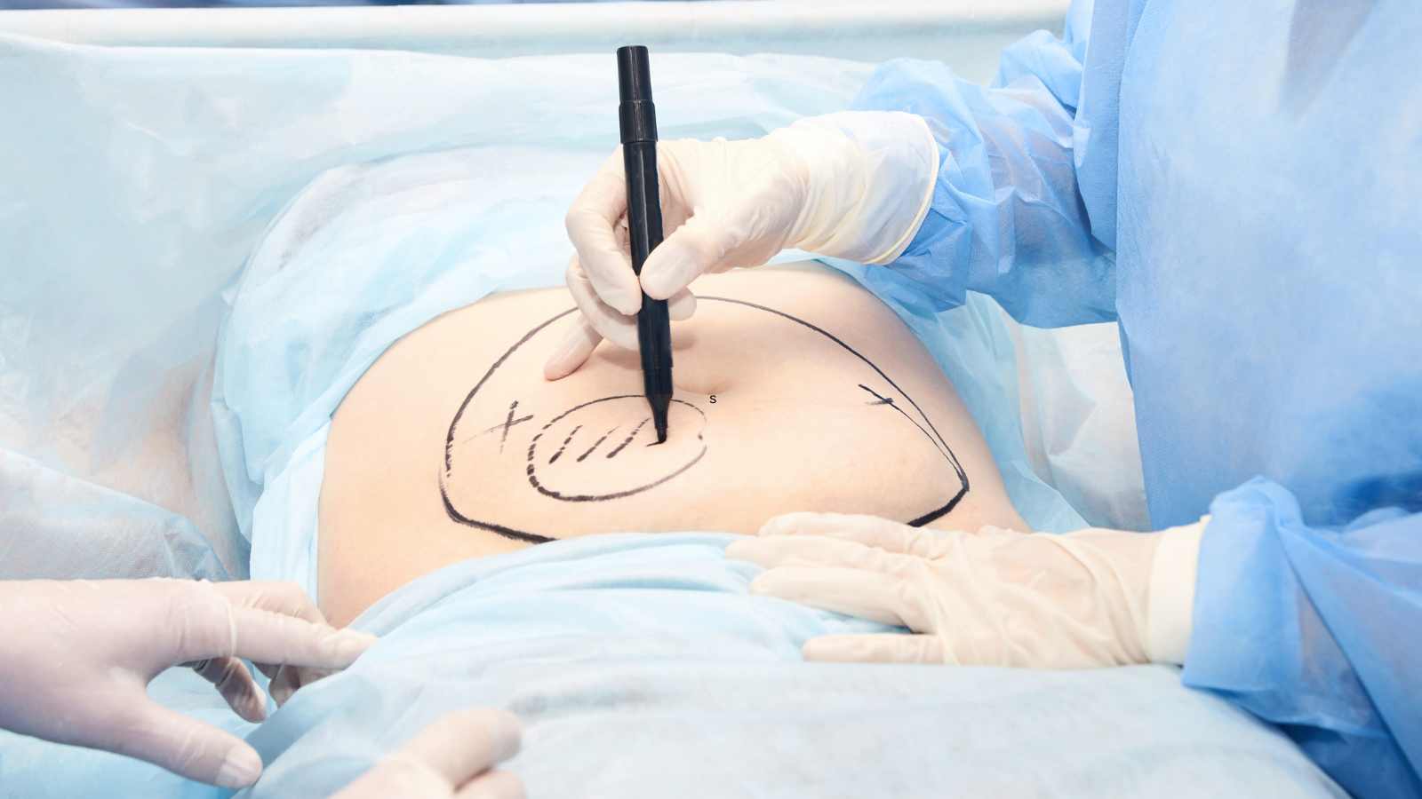 Liposuction