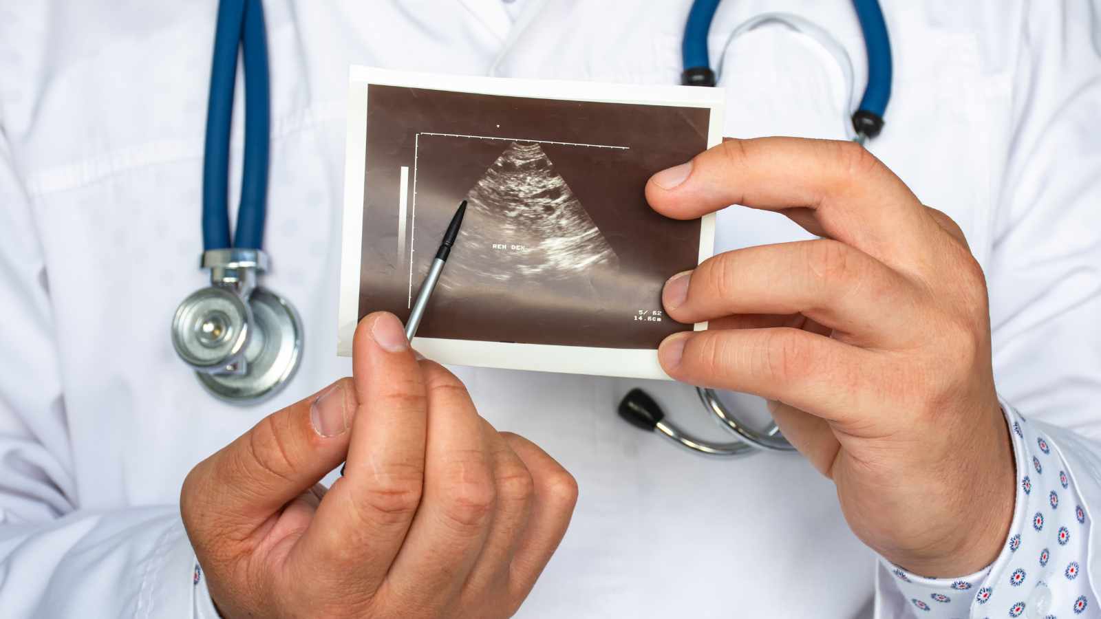 polycystic kidney disease