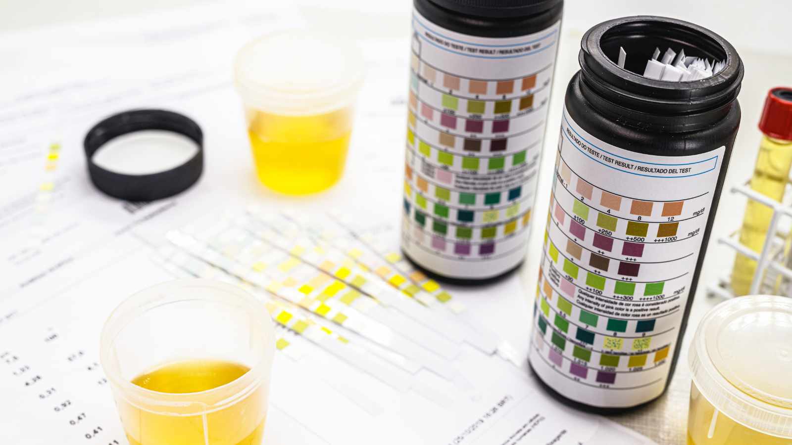 urine analysis for ketosis control