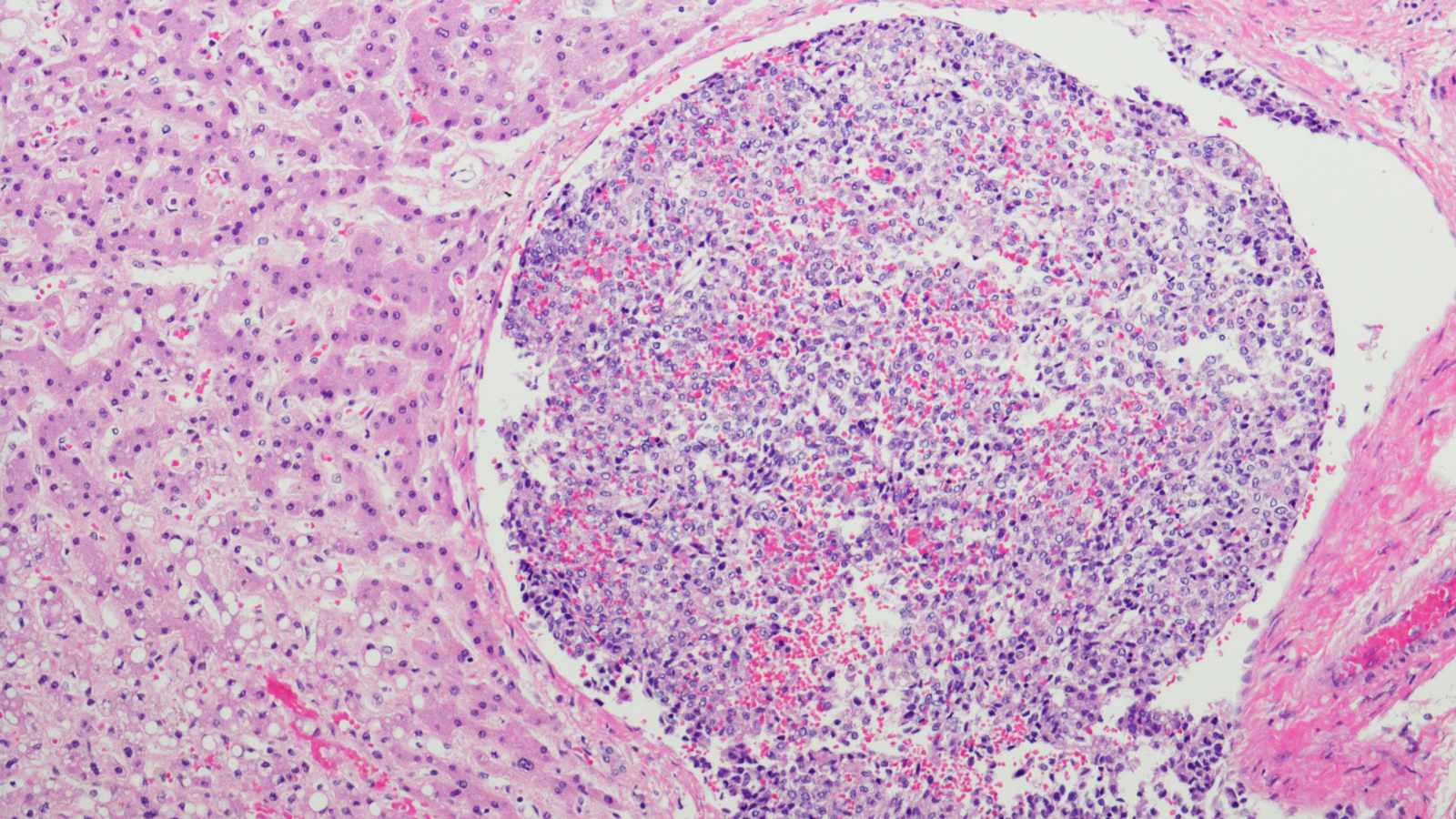 Hepatoblastoma