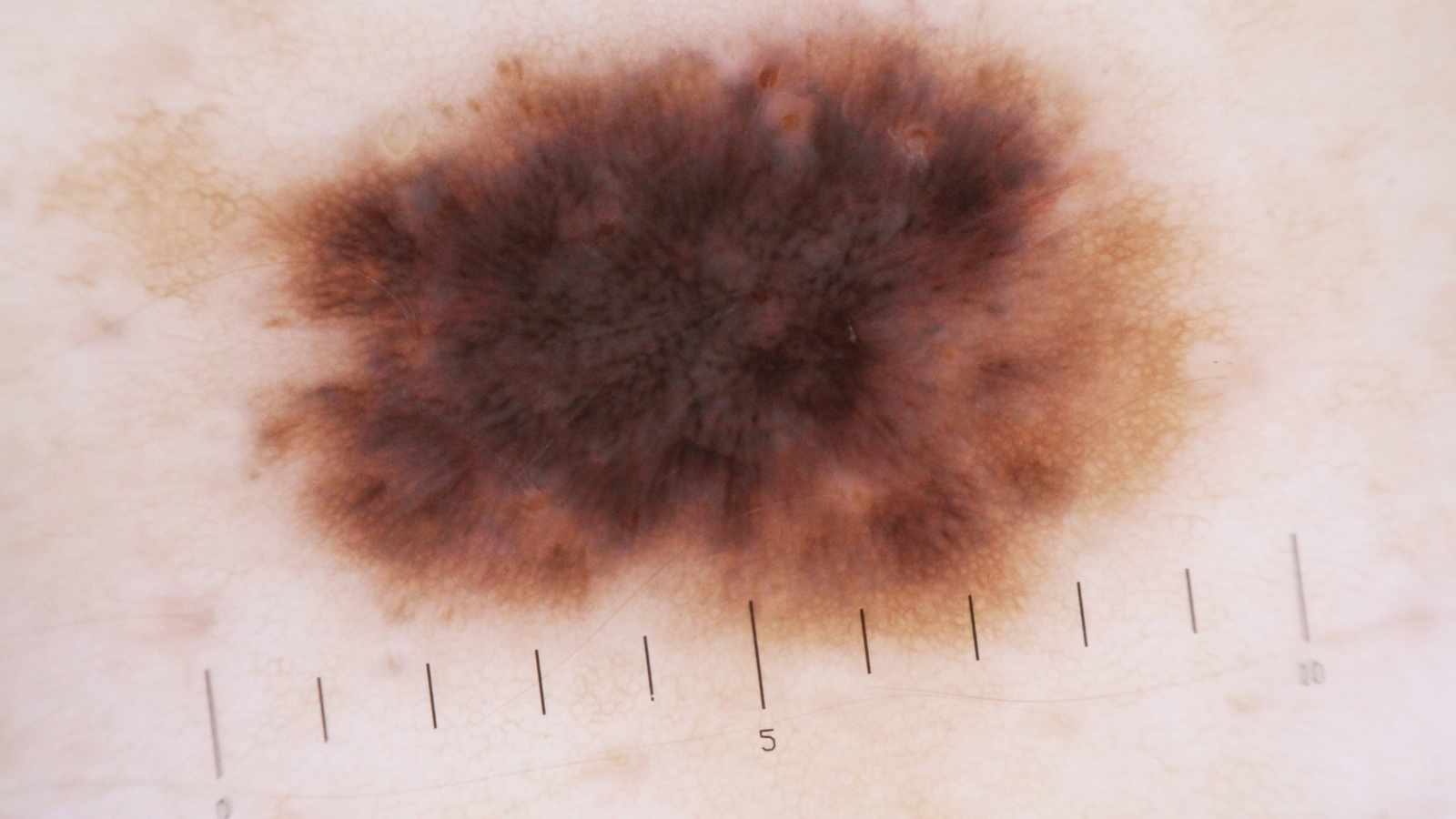 Uveal Melanoma
