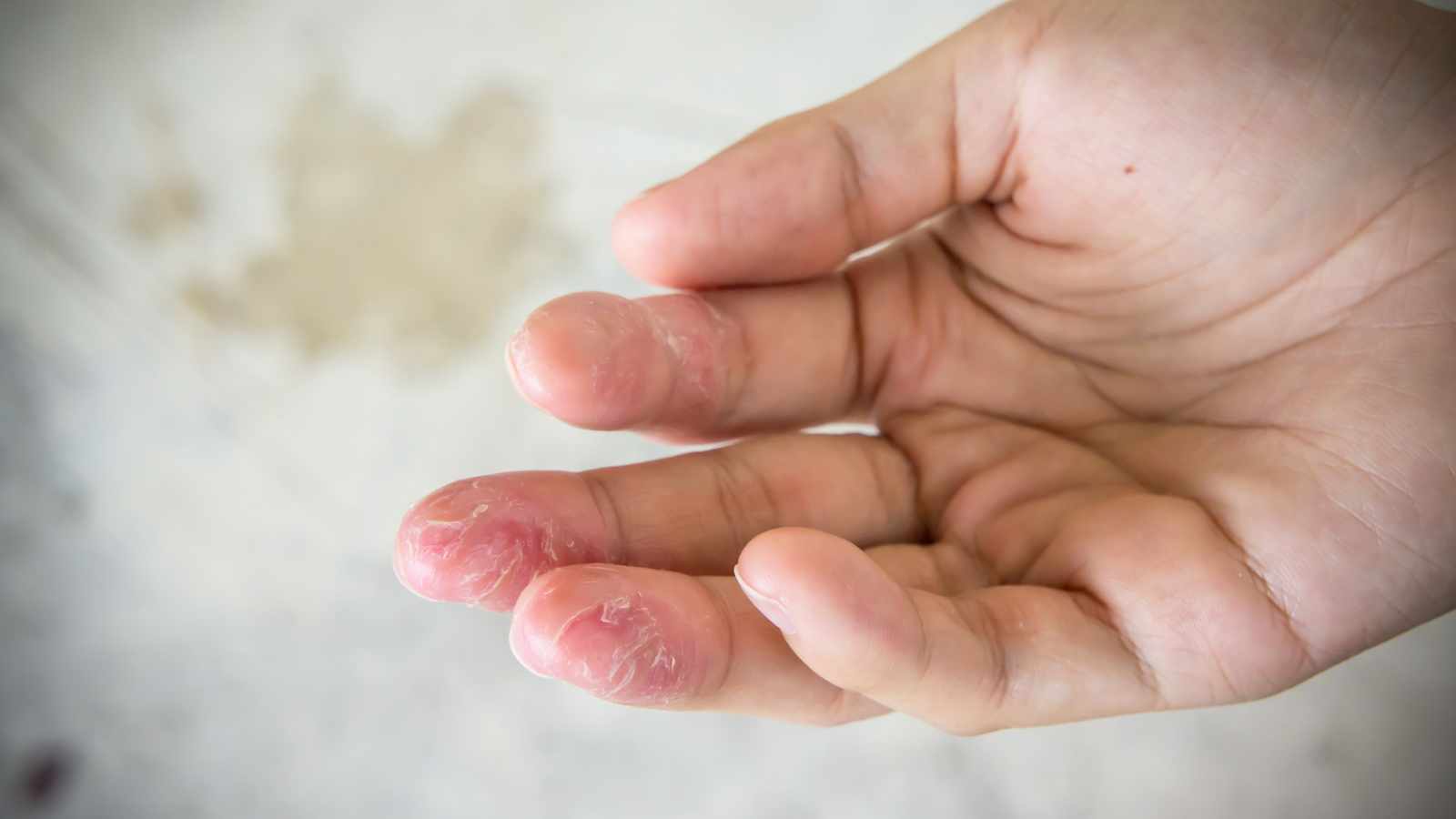 contact dermatitis on palm
